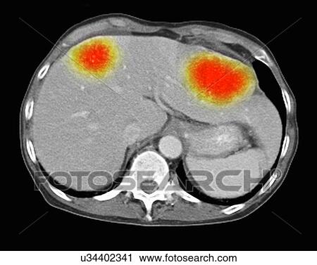 Image from a co-registered PET-CT study from dual modality scanner. Patient with multiple metastatic lesions in liver & lung. PET data superimposed over CT scan axial slice through liver metastases View Large Photo Image Stock Image - Image from a co-registered PET-CT study from dual modality scanner. Patient with multiple metastatic lesions in liver & lung. PET data superimposed over CT scan axial slice through liver metastases. Fotosearch
