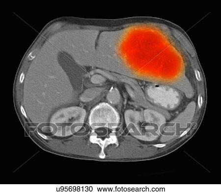 Image from a co-registered PET-CT study from dual modality scanner. Patient with multiple metastatic lesions in liver & lung. PET data superimposed over CT scan axial slice through liver metastases View Large Photo Image Stock Image - Image from a co-registered PET-CT study from dual modality scanner. Patient with multiple metastatic lesions in liver & lung. PET data superimposed over CT scan axial slice through liver metastases. Fotosearch