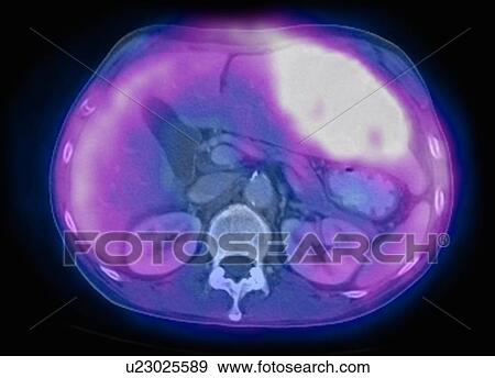 Stock Photo - Image from a co-registered PET-CT study from dual modality scanner. Patient with multiple metastatic lesions in liver & lung. PET data superimposed over CT scan axial slice through liver metastases. Fotosearch