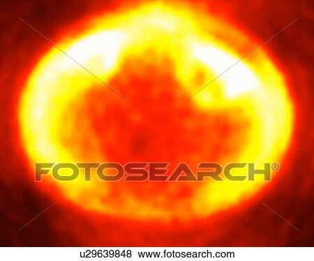 Stock Photo - Image from a co-registered PET-CT study from dual modality scanner. Patient with multiple metastatic lesions in liver & lung. PET data superimposed over CT scan axial slice through liver metastases. Fotosearch