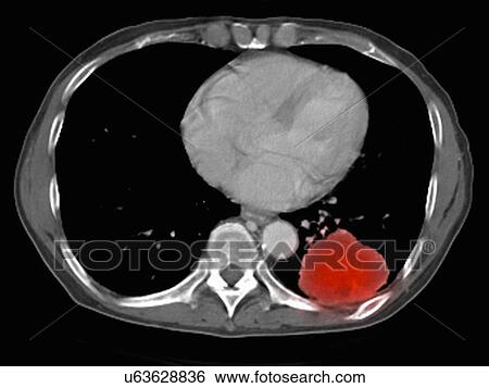 Image from a co-registered PET-CT study from dual modality scanner. Patient with multiple metastatic lesions in liver & lung. PET data superimposed over CT scan axial slice through lung metastases View Large Photo Image Stock Photograph - Image from a co-registered PET-CT study from dual modality scanner. Patient with multiple metastatic lesions in liver & lung. PET data superimposed over CT scan axial slice through lung metastases. Fotosearch