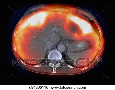 Image from a co-registered PET-CT study from dual modality scanner. Patient with multiple metastatic lesions in liver & lung. PET data superimposed over CT scan axial slice through liver metastases View Large Photo Image Stock Photograph - Image from a co-registered PET-CT study from dual modality scanner. Patient with multiple metastatic lesions in liver & lung. PET data superimposed over CT scan axial slice through liver metastases. Fotosearch