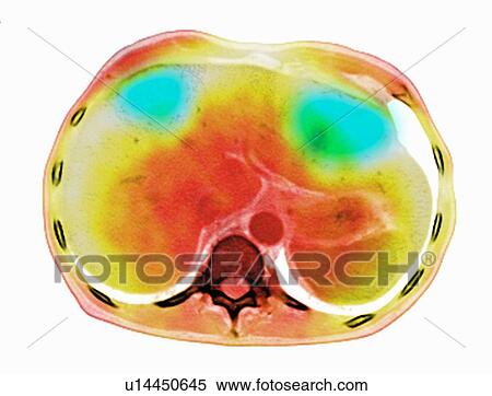 Image from a co-registered PET-CT study from dual modality scanner. Patient with multiple metastatic lesions in liver & lung. PET data superimposed over CT scan axial slice through liver metastases View Large Photo Image Stock Photography - Image from a co-registered PET-CT study from dual modality scanner. Patient with multiple metastatic lesions in liver & lung. PET data superimposed over CT scan axial slice through liver metastases. Fotosearch