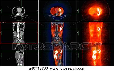 Stock Image - Image from co-registered PET-CT study from dual modality scanner. Patient with multiple metastatic lesions in liver & lung. PET data superimposed over CT scan axial slice through lung metastases. Fotosearch