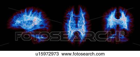 Sagittal, axial, coronal views of a full brain human connections. The images are colored by fiber density View Large Photo Image Stock Image - Sagittal, axial, coronal views of a full brain human connections. The images are colored by fiber density. Fotosearch