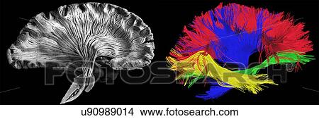 Picture - Sagittal, side view. Left - picture of a human brain dissection by a neuroanatomist, Right - reconstructed fibers by tractography. Fotosearch