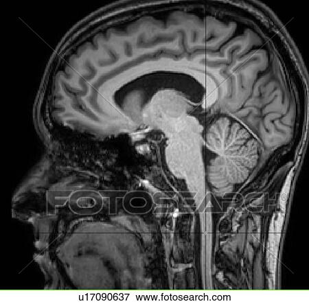 Stock Photo - Sagittal view of the brain and spinal cord on a T1 image. Fotosearch