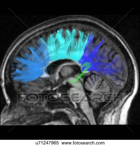 Stock Photography - Side view of the corpus callosum fibers. The largest structure connecting left and right hemisphere. Fotosearch