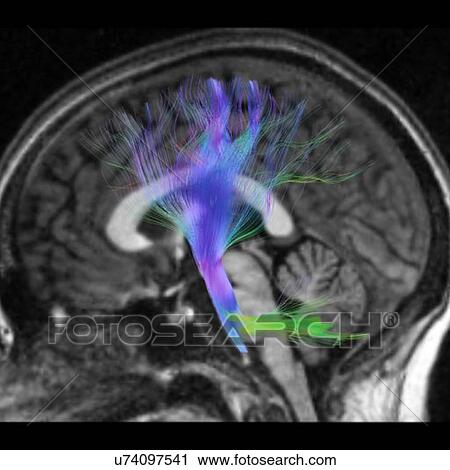 Side view of the motor tract, the corticospinal tract View Large Photo Image Stock Image - Side view of the motor tract, the corticospinal tract. Fotosearch