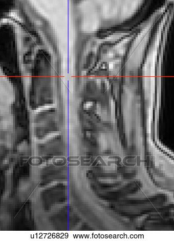 Stock Photo - Spinal cord of a healthy control. Anatomical T1 weighted image. Fotosearch