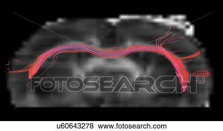 Stock Photo - The corpus callosum of a rat brain, in axial plane. Fotosearch