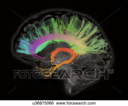Stock Photograph - The fiber tracts involved in aging. The splenium and genu of the corpus callosum, the fornix and the cingulum bundle. Human subject. Fotosearch