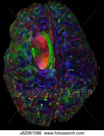 Top view of a cortical mesh, colored with diffusion orientation in Red-Green-Blue (Left-Right, Front-Back, Inferior-Superior) and the tumor cavity showing a hole View Large Photo Image Stock Photograph - Top view of a cortical mesh, colored with diffusion orientation in Red-Green-Blue (Left-Right, Front-Back, Inferior-Superior) and the tumor cavity showing a hole. Fotosearch