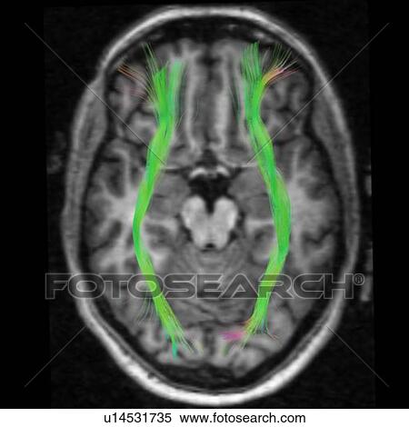 Top view of the fronto-occipittal connections, connecting frontal and occipital (vision) lobe View Large Photo Image Stock Photography - Top view of the fronto-occipittal connections, connecting frontal and occipital (vision) lobe. Fotosearch