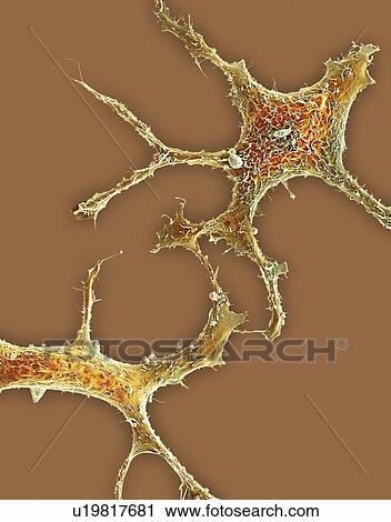 Clip Art - Breast cancer cells, SEM. Fotosearch