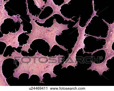 Clip Art - Breast cancer cells, SEM. Fotosearch