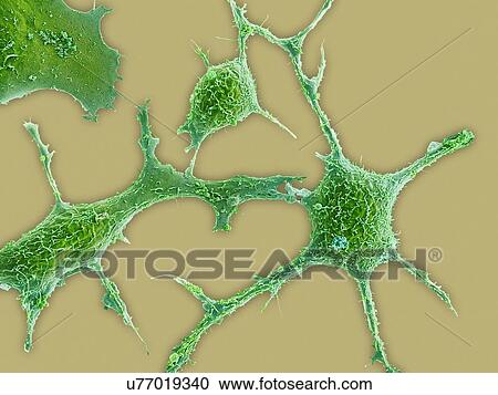 Clipart - Breast cancer cells, SEM. Fotosearch