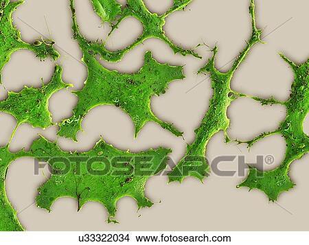 Stock Illustration - Breast cancer cells, SEM. Fotosearch