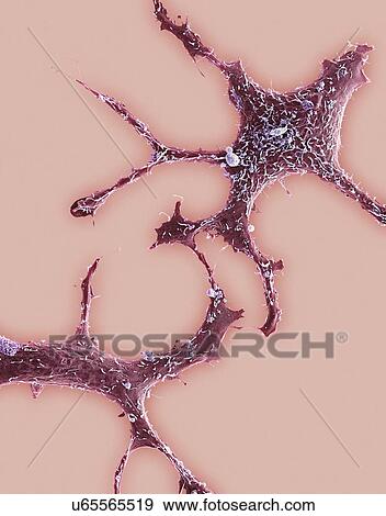 Breast cancer cells, SEM View Large Illustration Stock Illustration - Breast cancer cells, SEM. Fotosearch