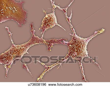 Breast cancer cells, SEM View Large Illustration Stock Illustration - Breast cancer cells, SEM. Fotosearch