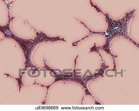 Breast cancer cells, SEM View Large Illustration Stock Illustration - Breast cancer cells, SEM. Fotosearch