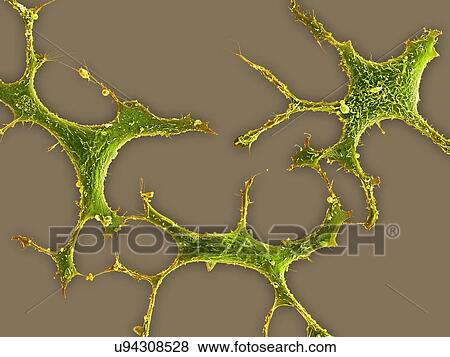 Breast cancer cells, SEM View Large Illustration Stock Illustration - Breast cancer cells, SEM. Fotosearch