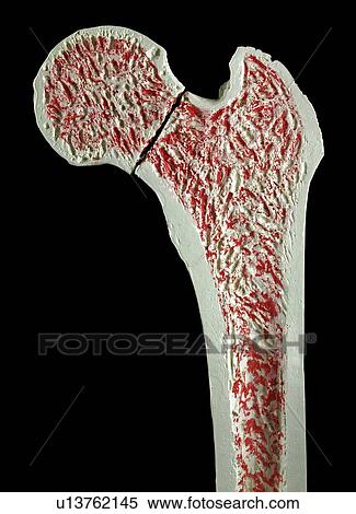 Stock Illustration - Fractured hip, artwork. Fotosearch
