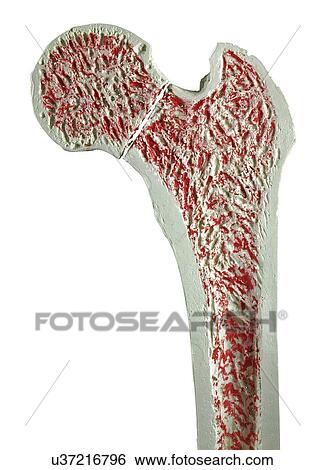 Stock Illustration - Fractured hip, artwork. Fotosearch