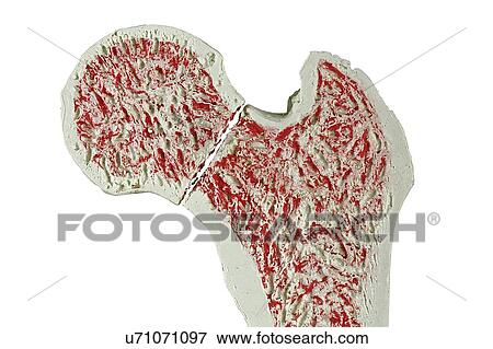 Fractured hip, artwork View Large Illustration Stock Illustration - Fractured hip, artwork. Fotosearch