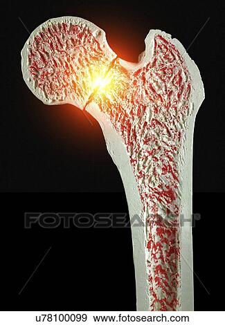 Stock Illustration - Fractured hip, artwork. Fotosearch