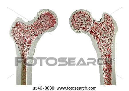 Normal and fractured hip View Large Illustration Stock Illustration - Normal and fractured hip. Fotosearch