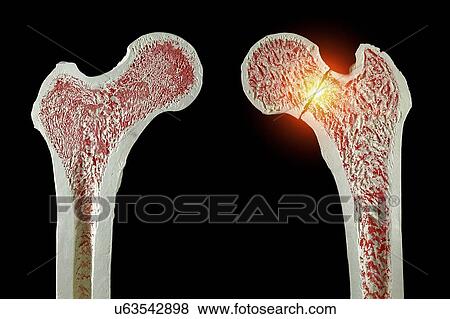 Normal and fractured hip View Large Illustration Stock Illustration - Normal and fractured hip. Fotosearch