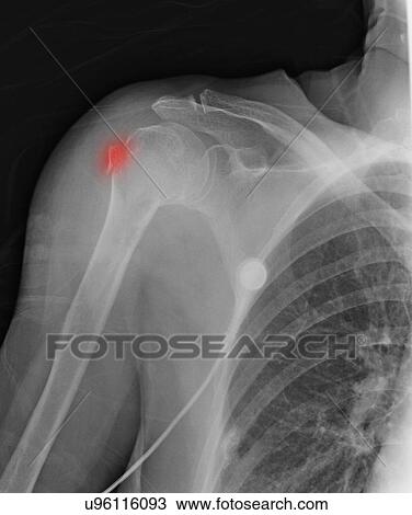Stock Image - "88 year old female with upper humerus fracture, and history of osteoporosis". Fotosearch