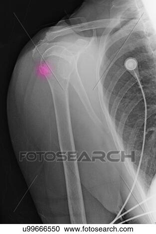 "88 year old female with upper humerus fracture, and history of osteoporosis" View Large Photo Image Stock Image - "88 year old female with upper humerus fracture, and history of osteoporosis". Fotosearch