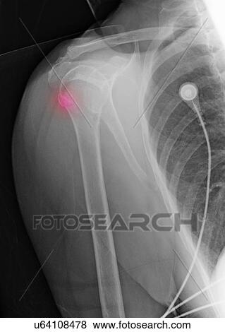 "88 year old female with upper humerus fracture, and history of osteoporosis" View Large Photo Image Stock Photo - "88 year old female with upper humerus fracture, and history of osteoporosis". Fotosearch