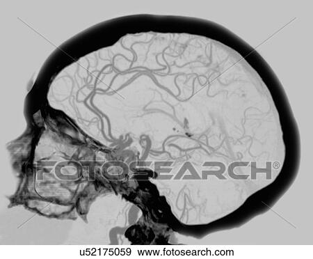 Stock Photo - "Angiogram CT showing the blood supply of the brain, including the Circle of Willis". Fotosearch