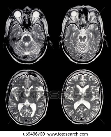 Stock Image - "Axial brain MRI images of a normal 65 year old woman. Some of the structure seen include the eyes, eye musculature, temporal lobes, occipital lobes, cerebellum, brainstem, ventricles". Fotosearch