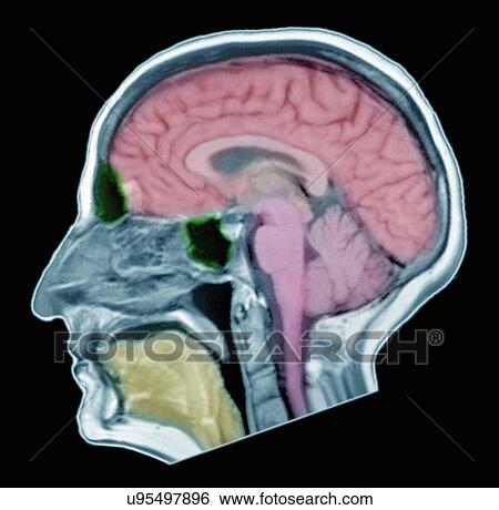 Stock Photograph - "Brain MRI of adult male, normal structures". Fotosearch