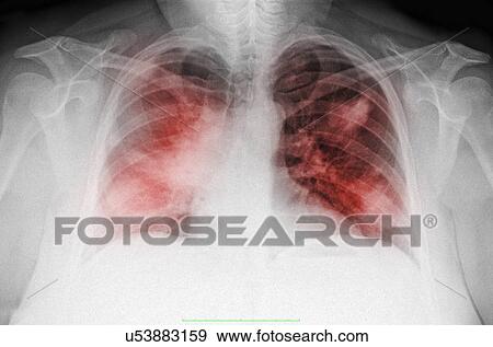 Stock Photo - "Chest x-ray of a 44 year old woman smoker, PA view, showing diffuse interstitial infiltrates suggestive of an atypical pneumonia". Fotosearch