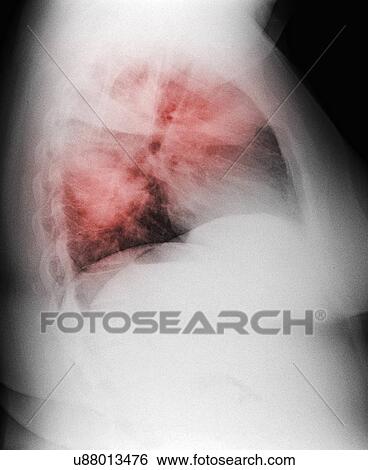 Stock Photograph - "Chest x-ray of a 44 year old woman smoker, showing diffuse interstitial infiltrates suggestive of an atypical pneumonia". Fotosearch