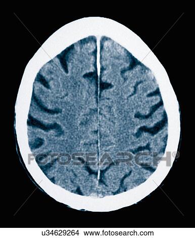 Picture - CT scan 84 year old male with Alzheimer's disease. CT shows brain atrophy with small gyri and large sulci. Fotosearch