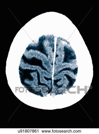 Stock Image - CT scan 84 year old male with Alzheimer's disease. CT shows brain atrophy with small gyri and large sulci. Fotosearch