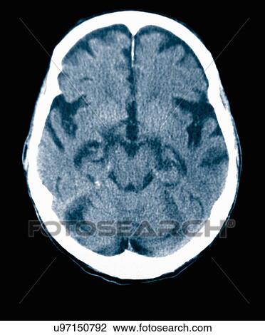 CT scan 84 year old male with Alzheimer's disease. CT shows brain atrophy with small gyri and large sulci View Large Photo Image Stock Image - CT scan 84 year old male with Alzheimer's disease. CT shows brain atrophy with small gyri and large sulci. Fotosearch