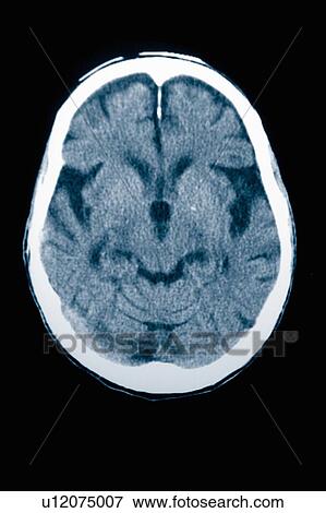 Stock Photo - CT scan 84 year old male with Alzheimer's disease. CT shows brain atrophy with small gyri and large sulci. Fotosearch