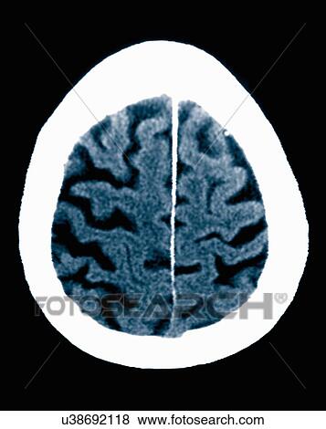 Stock Photo - CT scan 84 year old male with Alzheimer's disease. CT shows brain atrophy with small gyri and large sulci. Fotosearch
