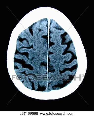 Stock Photo - CT scan 84 year old male with Alzheimer's disease. CT shows brain atrophy with small gyri and large sulci. Fotosearch