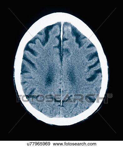 Stock Photo - CT scan 84 year old male with Alzheimer's disease. CT shows brain atrophy with small gyri and large sulci. Fotosearch