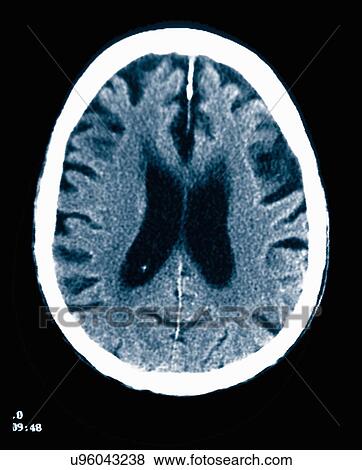 Stock Photo - CT scan 84 year old male with Alzheimer's disease. CT shows brain atrophy with small gyri and large sulci. Fotosearch