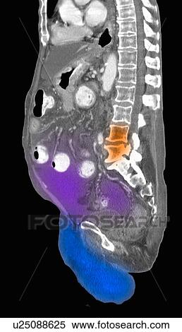 "CT scan with contrast of the abdomen and pelvis of an 87 year old man with a history of pancreatic carcinoma, and surgery. Scan shows a large amount of ascites fluid in the abdomen and scrotum" View Large Photo Image Stock Photography - "CT scan with contrast of the abdomen and pelvis of an 87 year old man with a history of pancreatic carcinoma, and surgery. Scan shows a large amount of ascites fluid in the abdomen and scrotum". Fotosearch