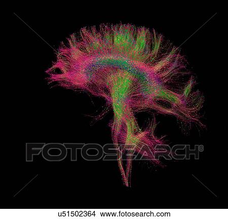 Picture - "Diffusion MRI, also referred to as diffusion tensor imaging or DTI, of the human brain". Fotosearch